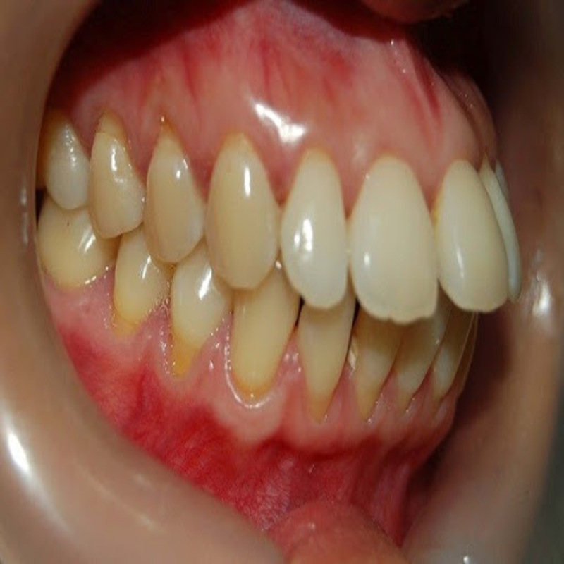 Những bất lợi do răng hô gây nên 
