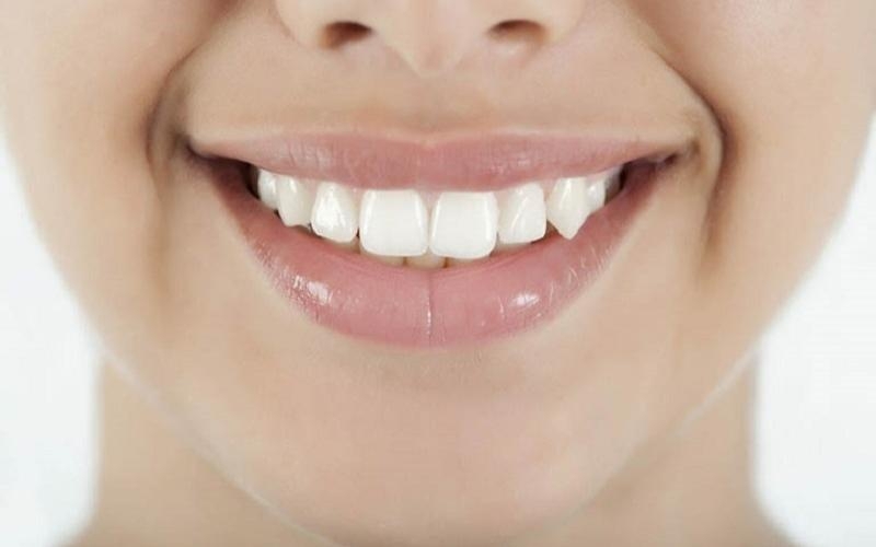 Đặc điểm của răng nanh là gì? 