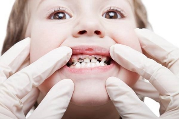 Cách điều trị sâu răng cho trẻ em 2 tuổi an toàn, hiệu quả