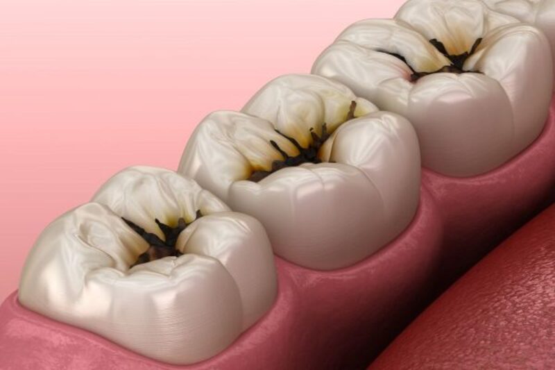 Cách điều trị bệnh sâu răng tận gốc từ các chuyên gia 