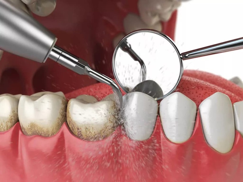 Sau khi lấy vôi răng nên lưu ý những gì?