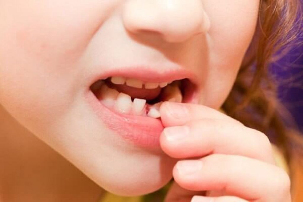 Gãy răng làm gia tăng khả năng bị một số bệnh lý về răng miệng 