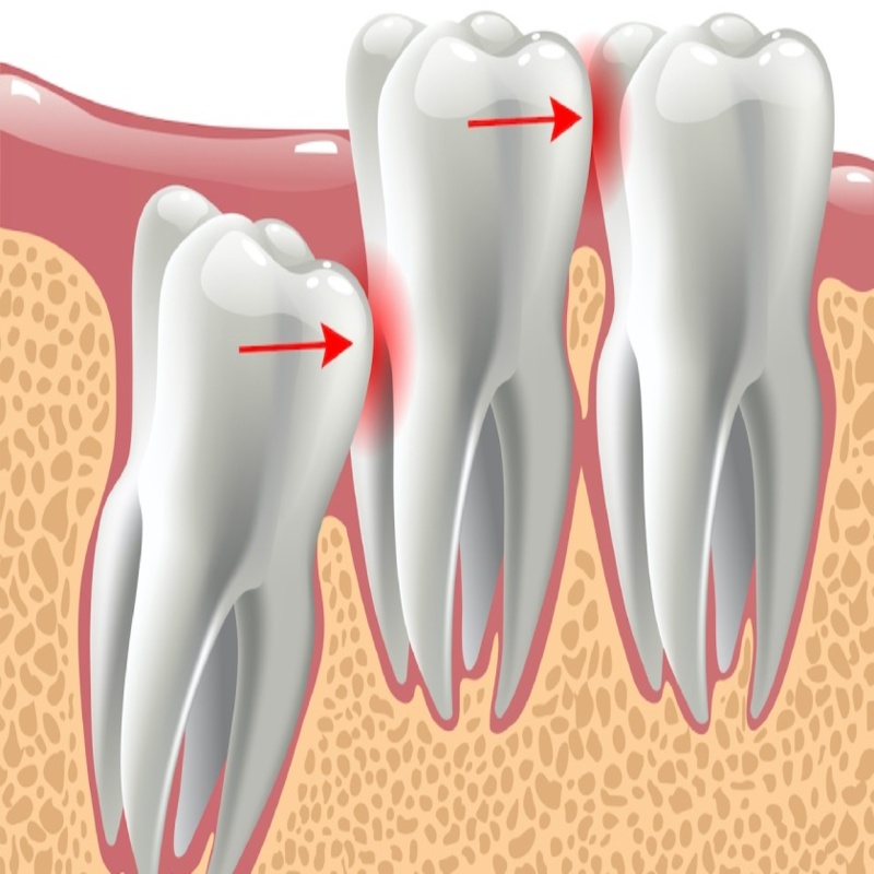 Răng khôn là răng gì? Vì sao cần phải loại bỏ?