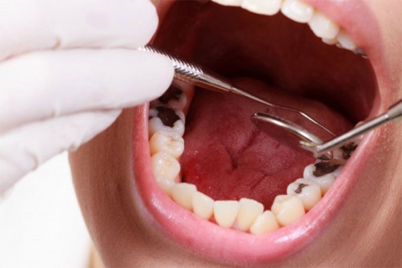 Có Cần Phải Điều Trị Tình Trạng Răng Sâu Hay Không?