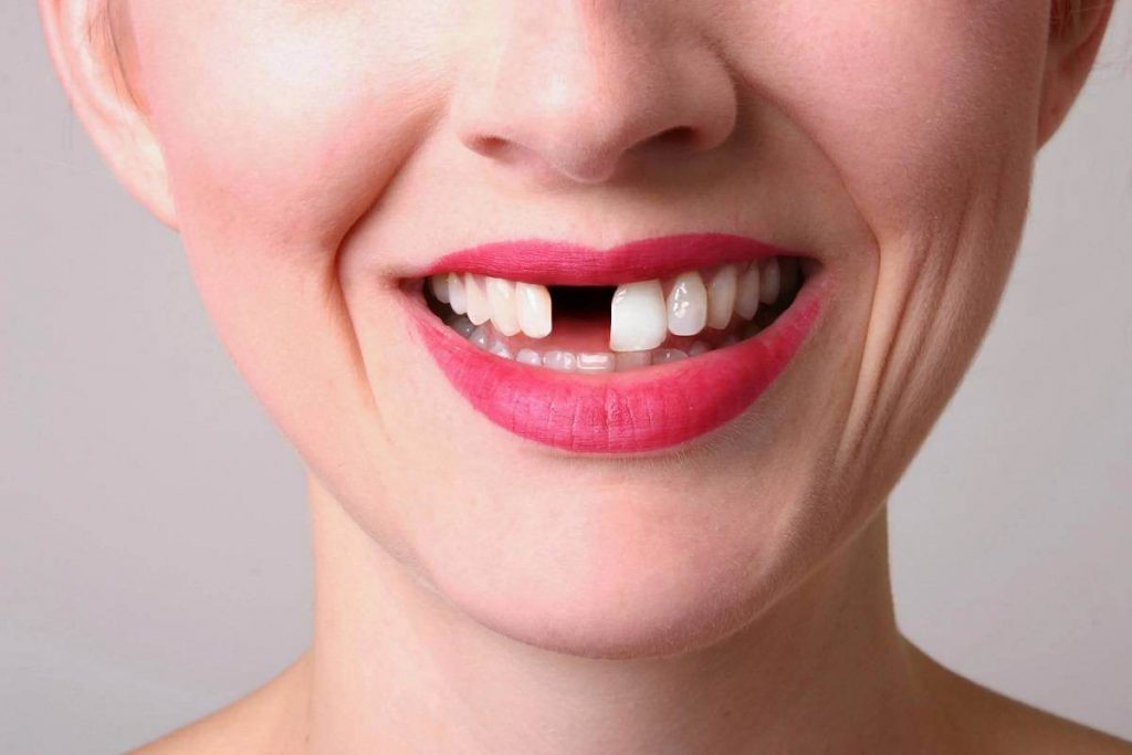 Gãy răng khác với rụng răng 