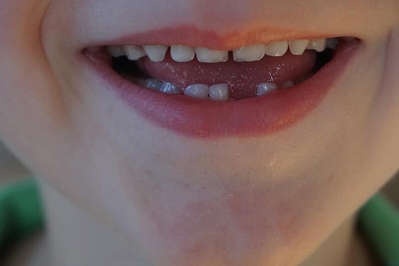 Rụng răng hàm dưới có ý nghĩa như thế nào?