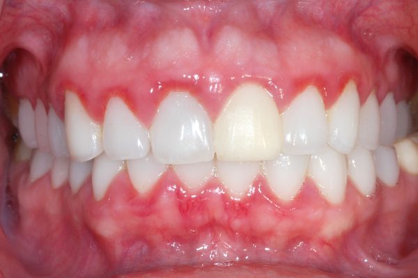 Hình ảnh viêm nướu răng 