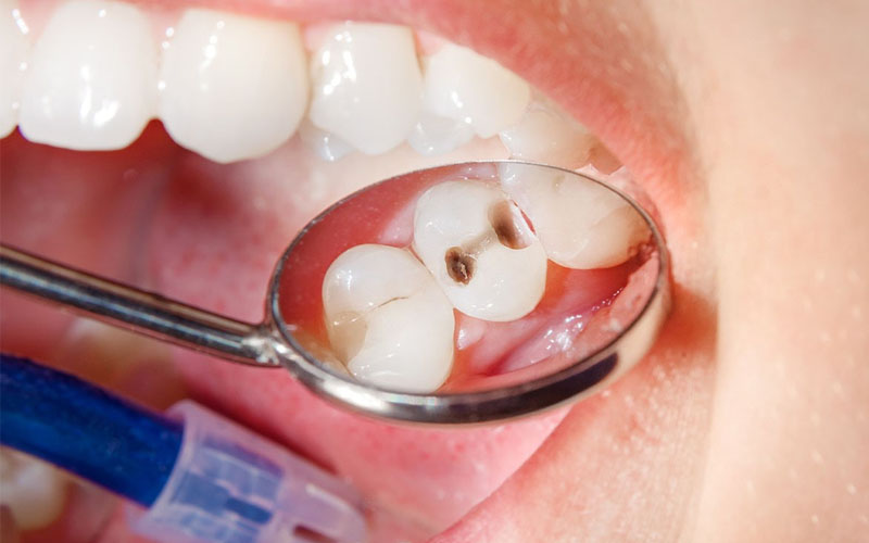Cách chữa sâu răng cho người lớn lớn