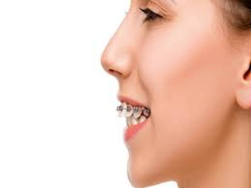 Niềng răng kết hợp phẫu thuật hàm