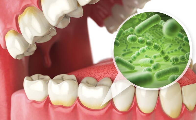 Lấy cao răng có ảnh hưởng gì đến sức khỏe không?