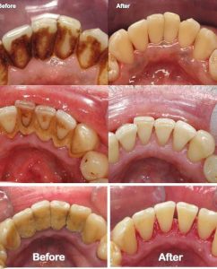 Một số lưu ý sau lấy vôi răng mà bạn nên biết