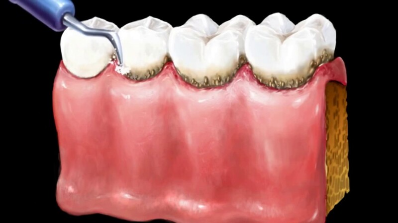 Tại sao chúng ta nên lấy vôi răng?