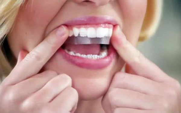 Miếng dán trắng răng là gì? 