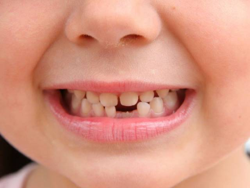 Mơ răng ở hàm dưới bị rụng