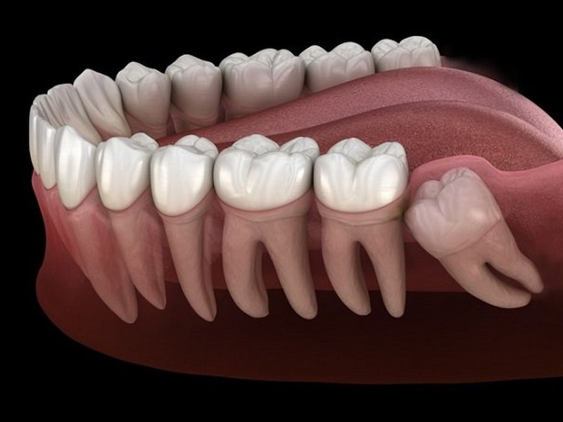 Mọc răng khôn hàm dưới có bắt buộc phải nhổ không?