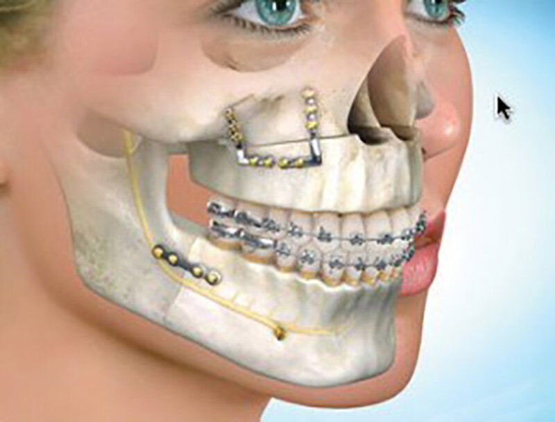 Nền xương răng của bệnh nhân tốt 