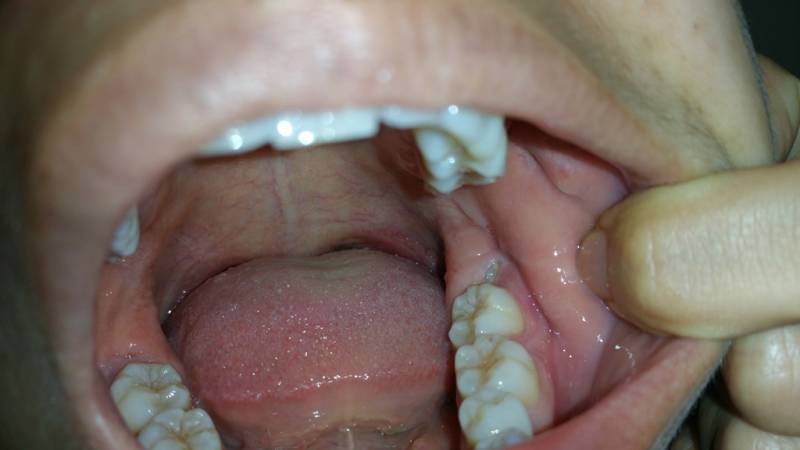 Tác hại của răng khôn gây nên 