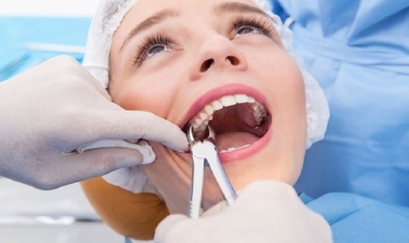 Nhổ răng khôn có nguy hiểm không? Những lưu ý cần biết