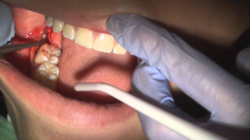 Chi phí nhổ răng khôn phụ thuộc vào độ khó của ca tiểu phẫu