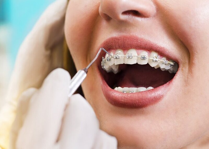 Cách nào giúp giảm ê buốt trong quá trình niềng răng? 