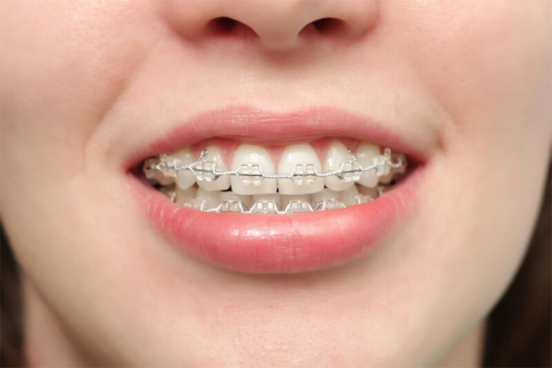 Thời gian niềng răng mất khoảng bao lâu?