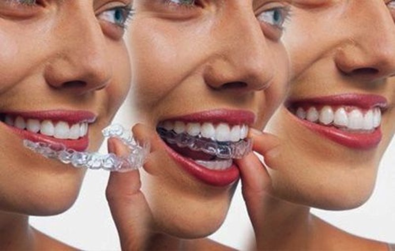 Phương pháp niềng răng Invisalign