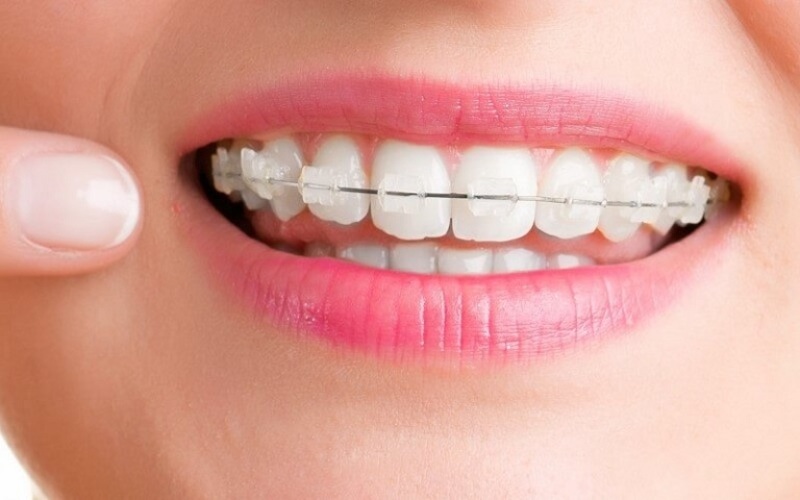 Tìm hiểu rõ về các phương pháp niềng răng