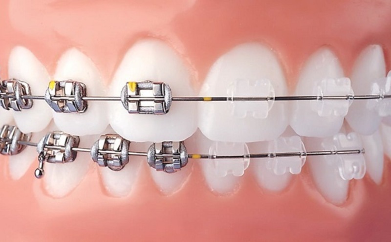 Phương pháp niềng răng kim loại