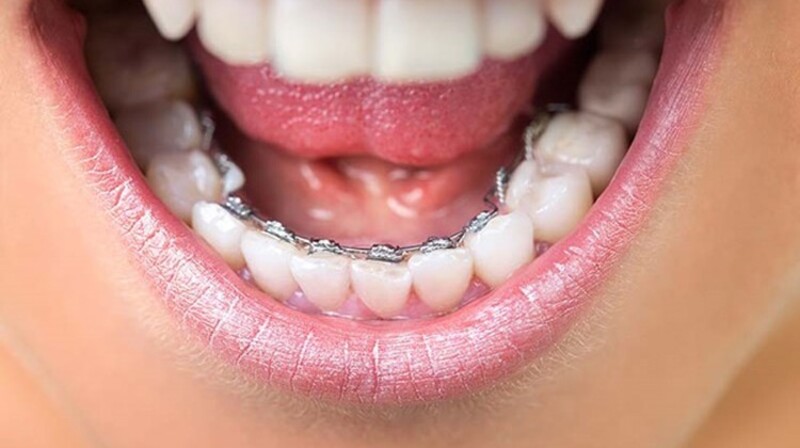  Niềng răng móm cải thiện góc chính diện và góc nghiêng 