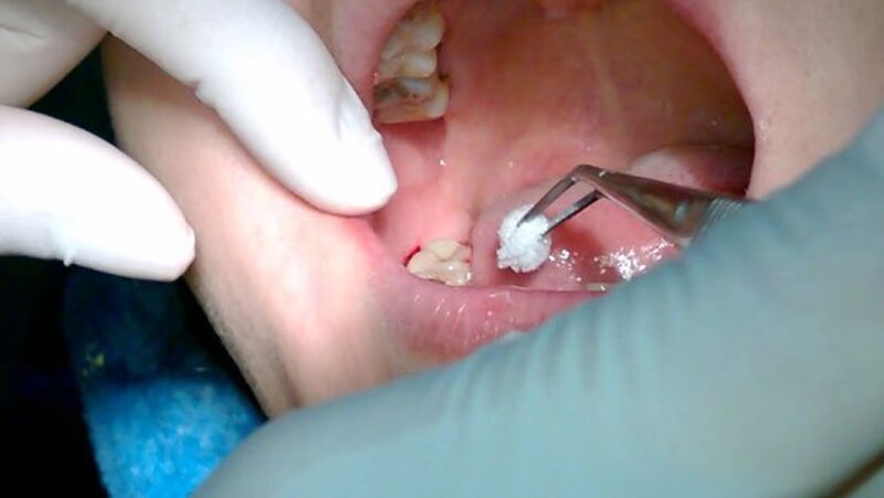 Nhổ răng khôn có gây đau đớn không? 