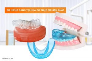 Niềng răng tại nhà có thực sự hiệu quả?