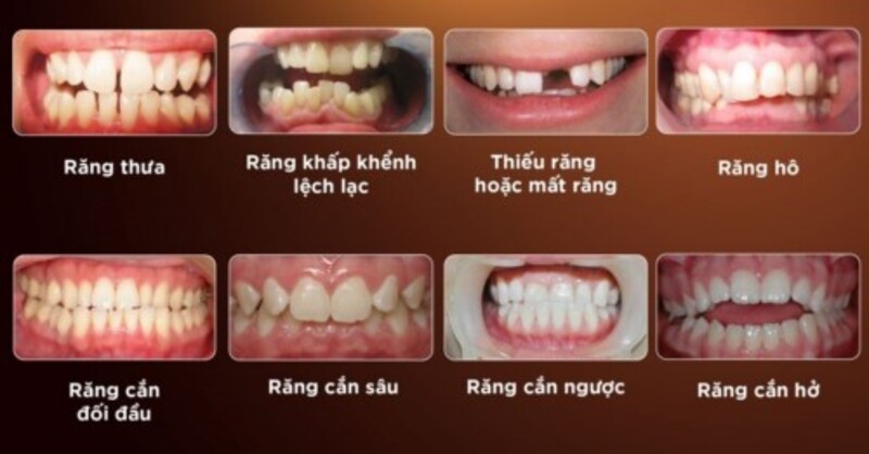 Trường hợp nào nên niềng răng?