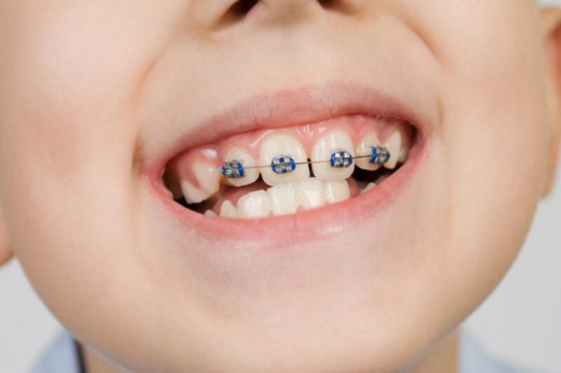 Niềng răng mất bao lâu?