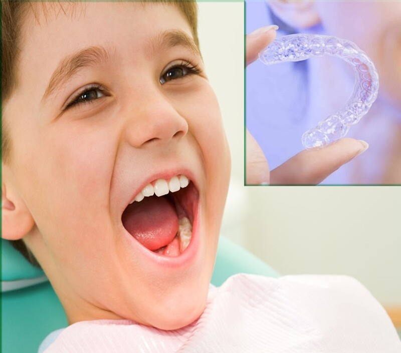  Niềng răng trẻ em không cần mắc cài (Invisalign) 