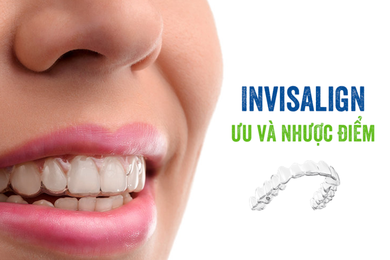 Những ưu và nhược điểm của niềng răng invisalign