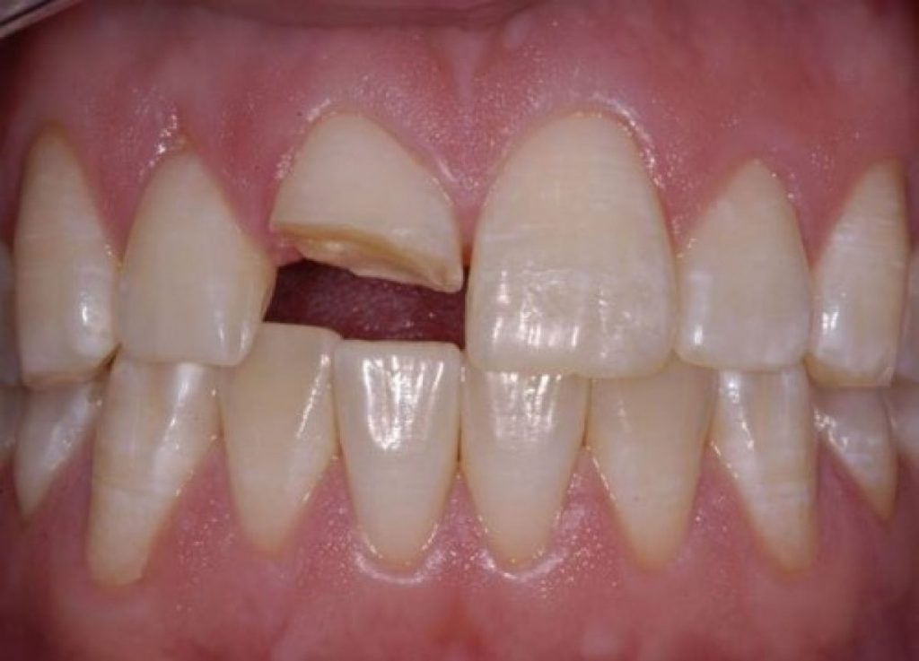  Gãy răng làm giảm thẩm mỹ
