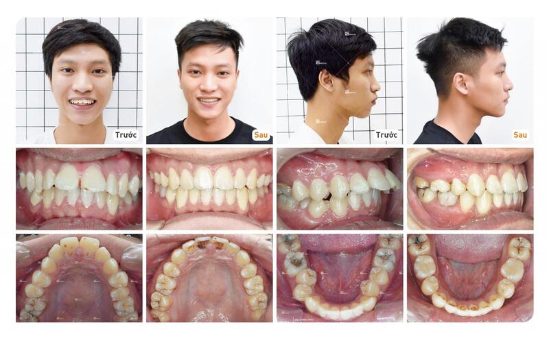  Niềng răng hô cải thiện góc chính diện và góc nghiêng 