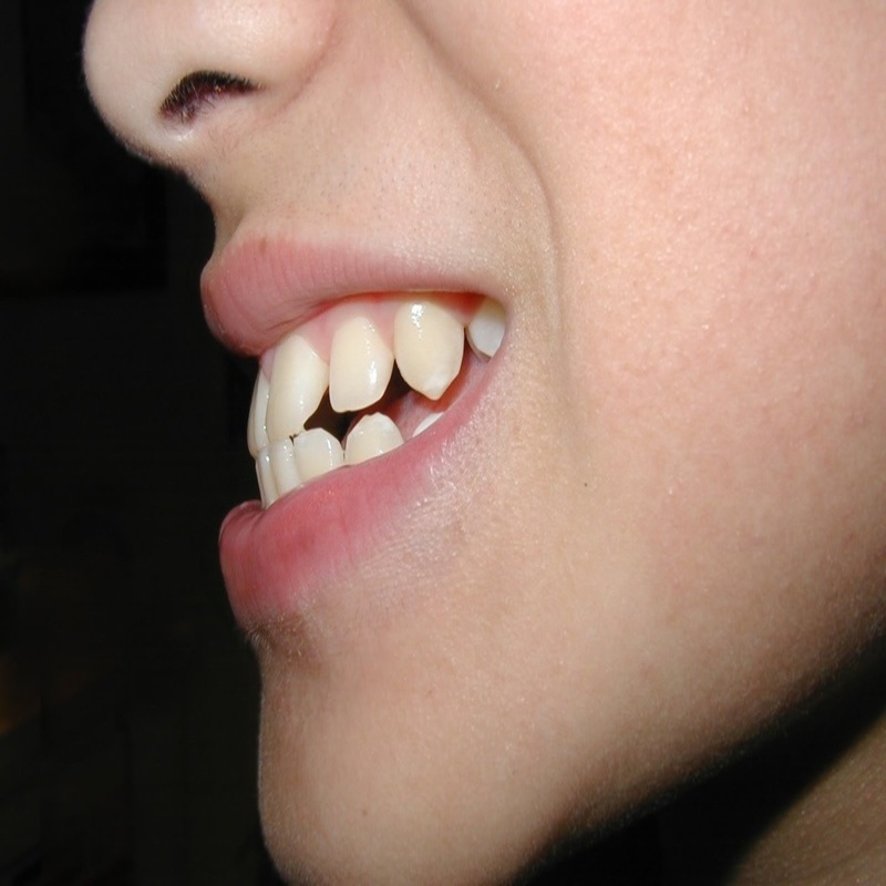 Răng hô là gì? Những phương pháp điều trị răng hô hiệu quả nhất