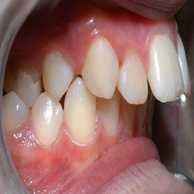 Biểu hiện của răng hô