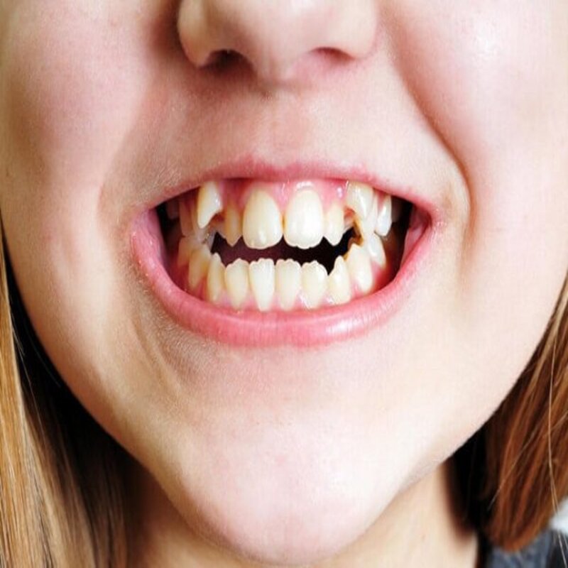 Nguyên nhân răng khểnh hình thành