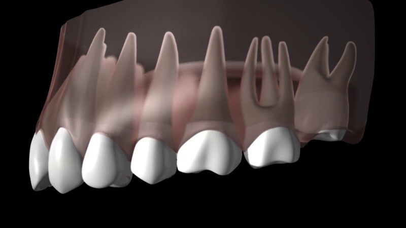 Răng khôn hàm trên là gì?