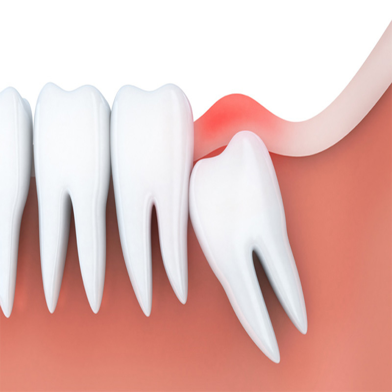 Răng khôn là răng nào? Những dấu hiệu nhận biết răng khôn đang mọc