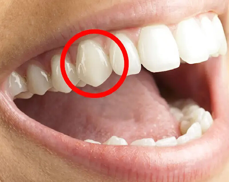 Răng nanh nằm ở vị trí nào? 