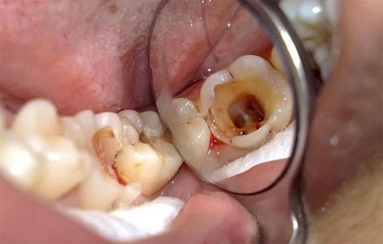 Sâu răng là gì? Nguyên nhân nào gây sâu răng