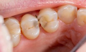 sâu răng giữa hai răng hàm