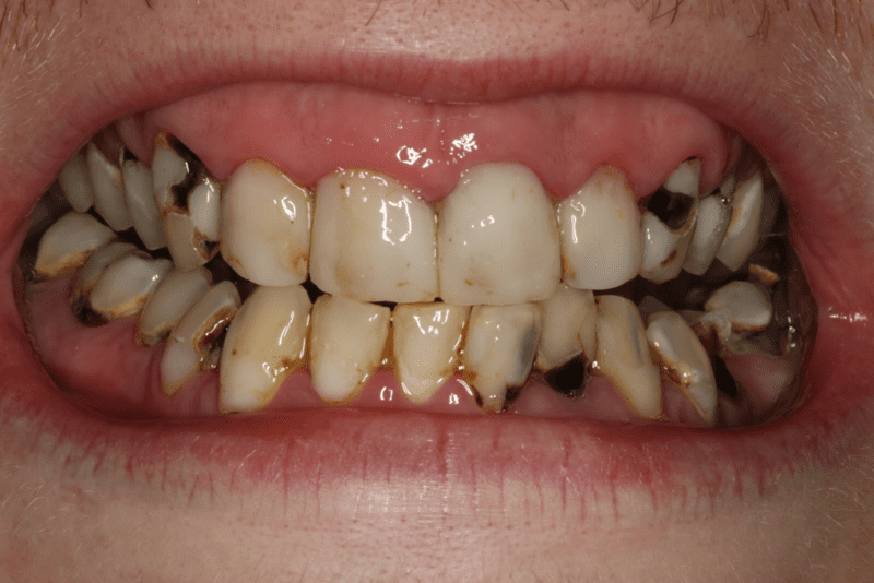 Cách Nhận Biết Tình Trạng Sâu Răng