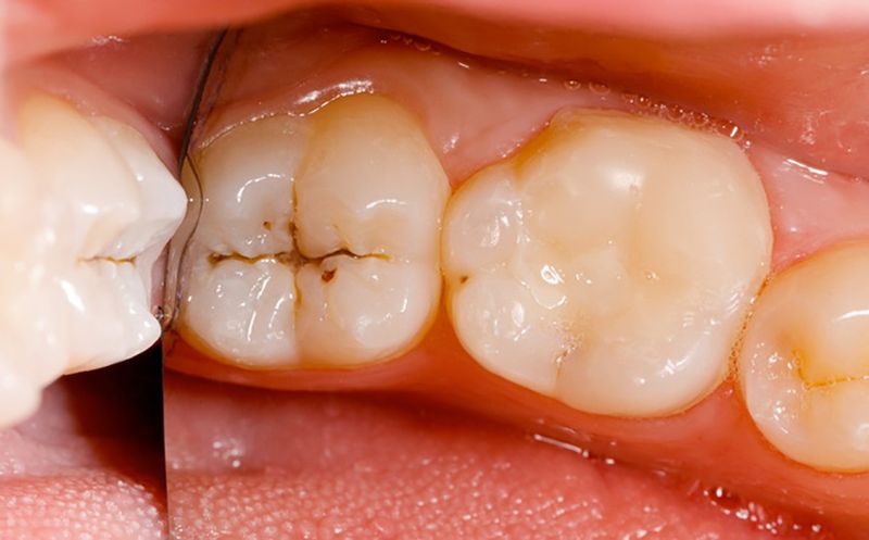 Những triệu chứng của sâu răng 