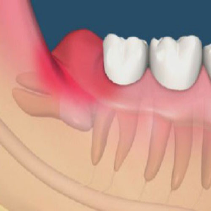 Răng khôn mọc làm sâu răng gây ảnh hưởng đến răng miệng 