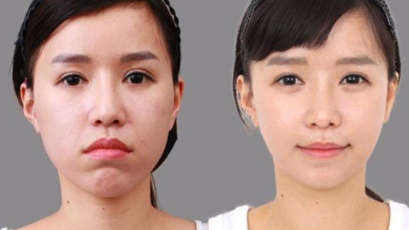 Sự khác biệt của khuôn mặt trước và sau khi niềng răng?