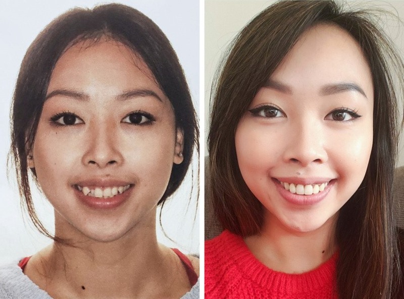 Khuôn mặt trước và sau khi niềng răng mọc lệch, răng khểnh nặng 